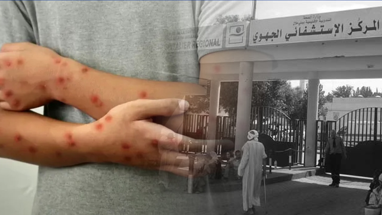 Suspected monkeypox case mobilizes Beni Mellal hospital